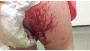 Image illustrant l'article Elle court vers sa maman, ensanglantée à cause de débris de verre laissés volontairement dans un toboggan ! Mise en garde:
