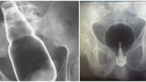 Image illustrant l'article Les docteurs dévoilent 17 objets glauques qu'ils ont dû retirer des parties génitales de leurs patients...