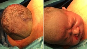 Image illustrant l'article La tête du bébé sort du ventre de la maman via une "césarienne naturelle".